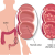 ulcerative-colitis.png